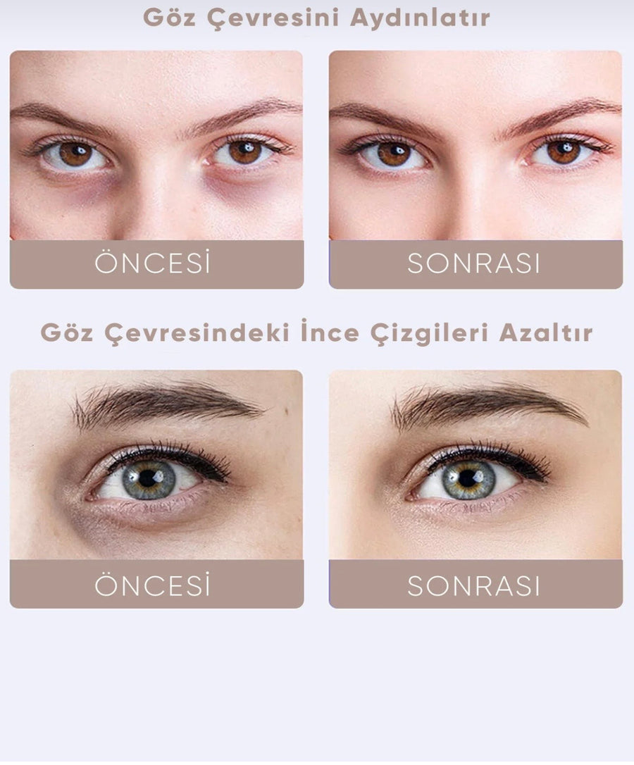 Göz altı morluğu önce sonra
